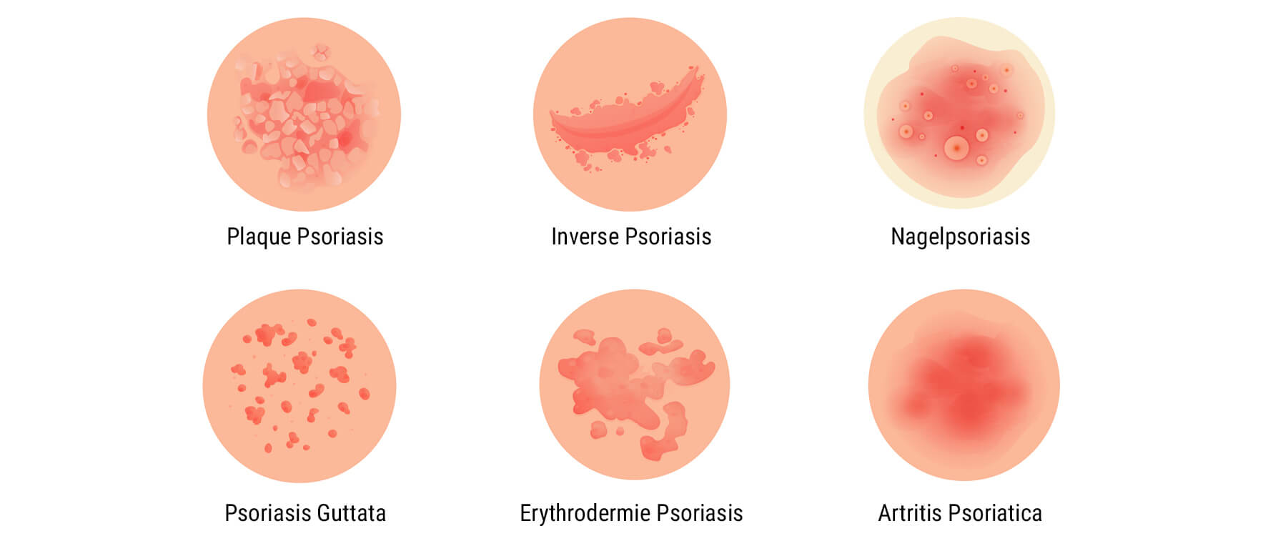 Wat Is Psoriasis?
