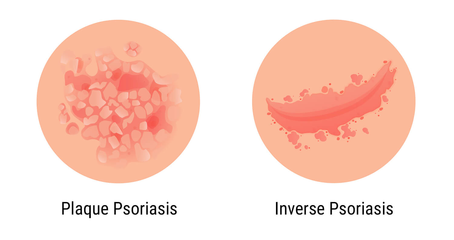 Wat Is Psoriasis? Wat Is Psoriasis?