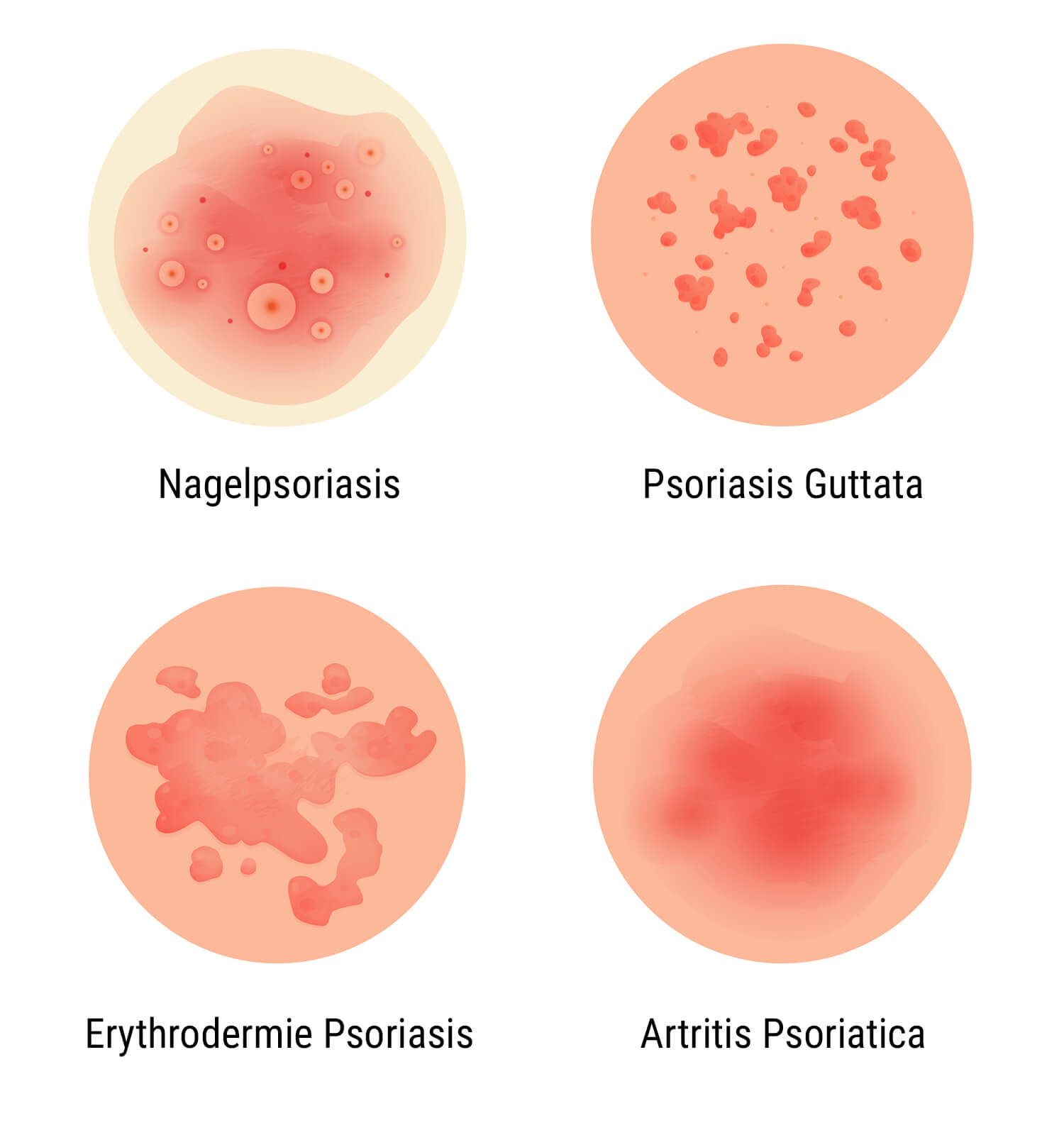 Wat Is Psoriasis? Wat Is Psoriasis?