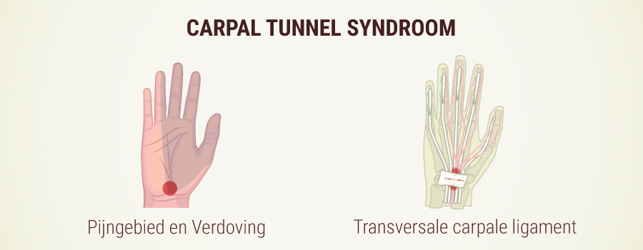 WAT IS HET CARPAAL TUNNEL SYNDROOM?