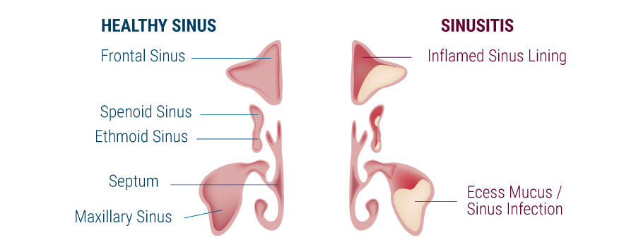 Ontsteking Des Sinus