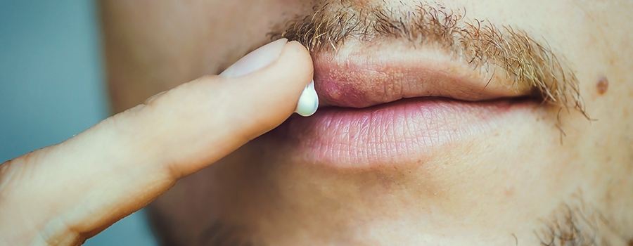 cannabis behandeling voor herpes cannabis behandeling voor herpes