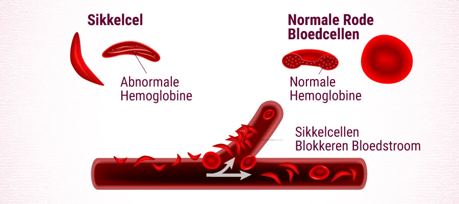 Sikkelcel Versus Normale Rode Bloedcellen Sikkelcel Versus Normale Rode Bloedcellen