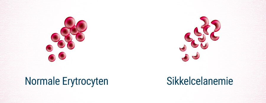 Sikkelcelanemie Sikkelcelanemie
