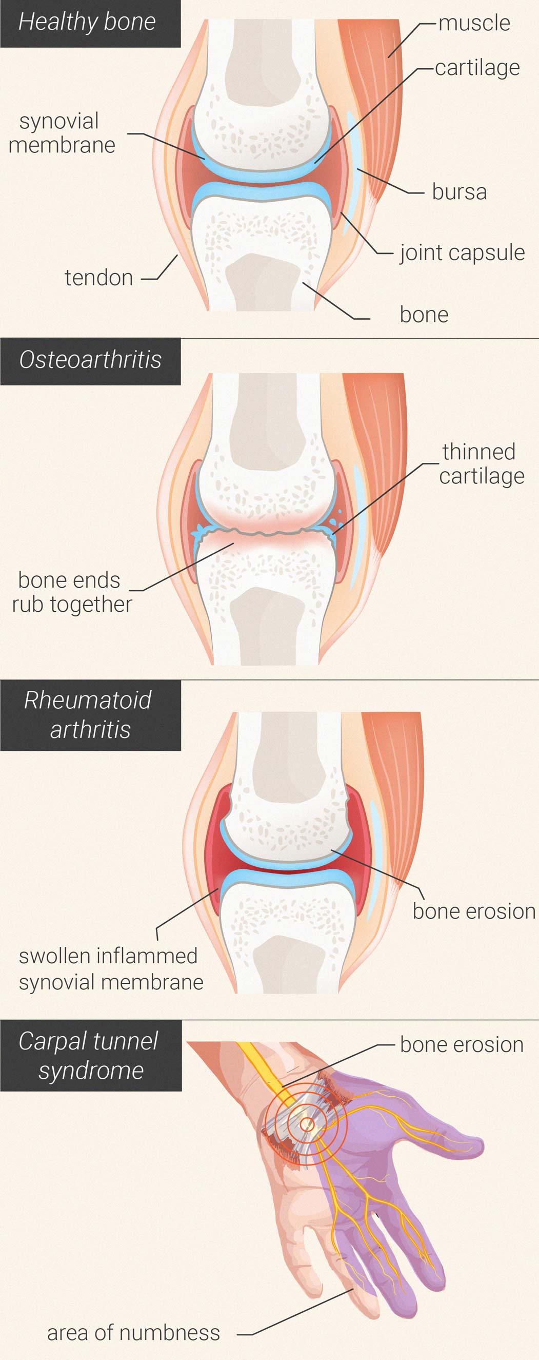 Kan wiet de pijn en ontstekingen bij artritis verminderen?