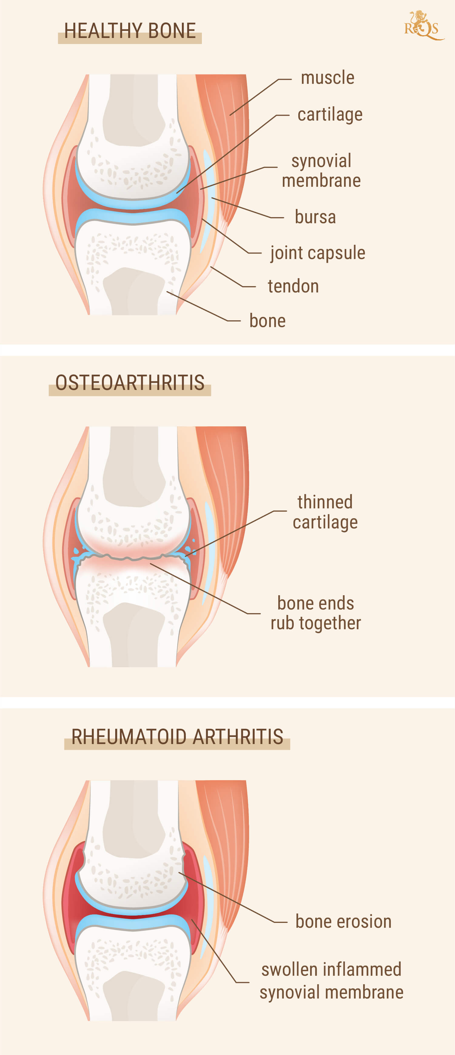 Zijn artritis en reuma hetzelfde?