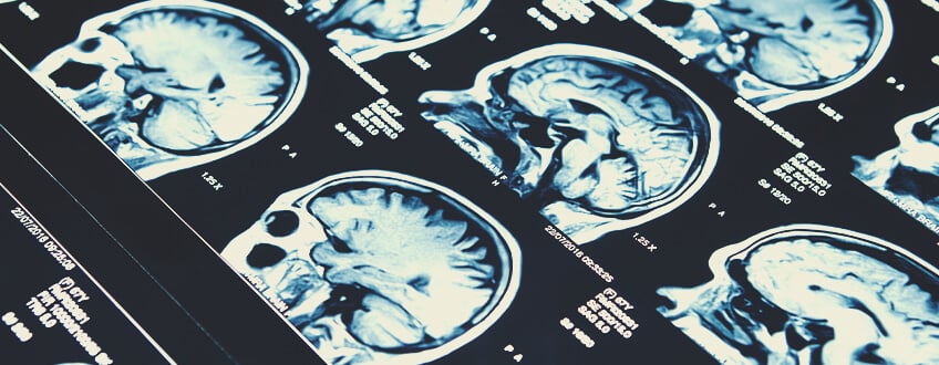 CBD en epilepsie CBD en epilepsie
