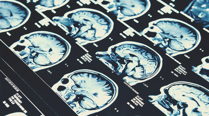 CBD en epilepsie CBD en epilepsie