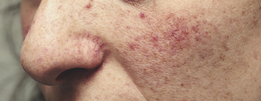 Hoe ontstaat rosacea? Hoe ontstaat rosacea?