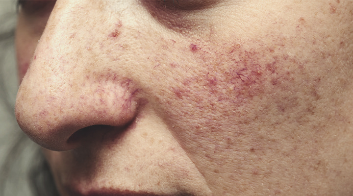 Hoe ontstaat rosacea? Hoe ontstaat rosacea?