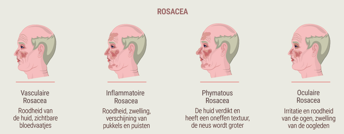 Wat is rosacea? Wat is rosacea?