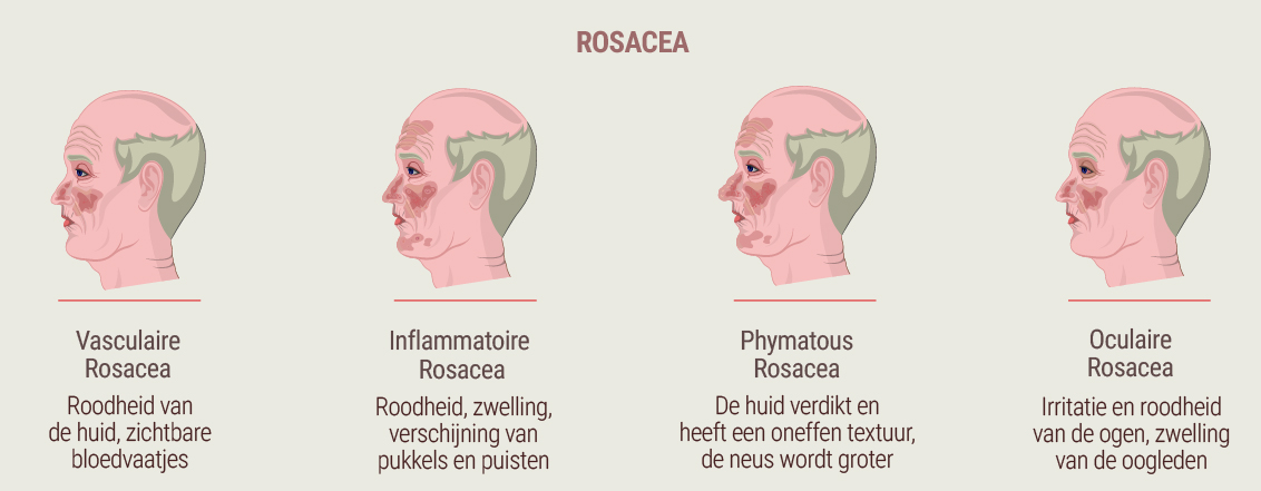 Wat is rosacea?