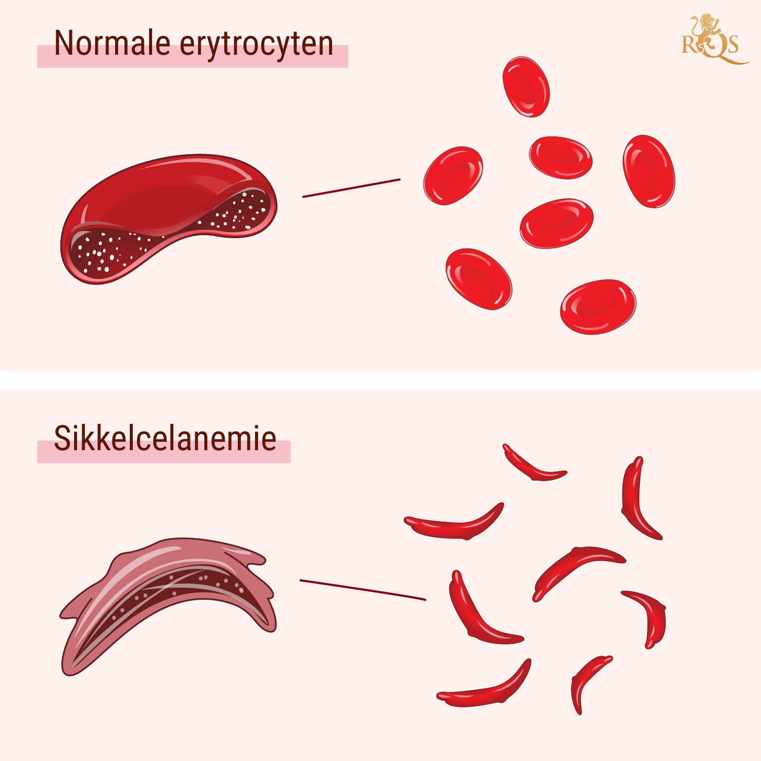 Wat is sikkelcelanemie?