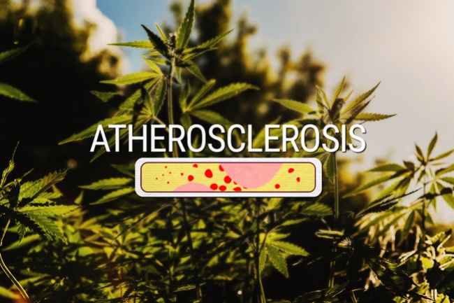 Is Cannabis Effectief In De Behandeling Van Atherosclerose?